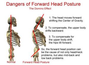 forward-head-posture-dysfunction