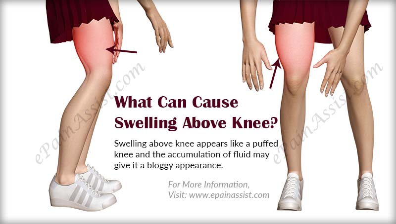 what-can-cause-swelling-above-knee-preview