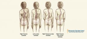 Terms-and-classification-of-scoliosis