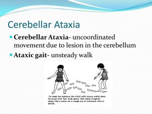Ataxic gait- unsteady walk.