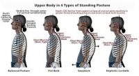 Kyphosis, round shoulders and dowagers hump