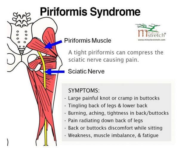 Sciatica & piriformis syndrome - A constant confusion & do they exist?