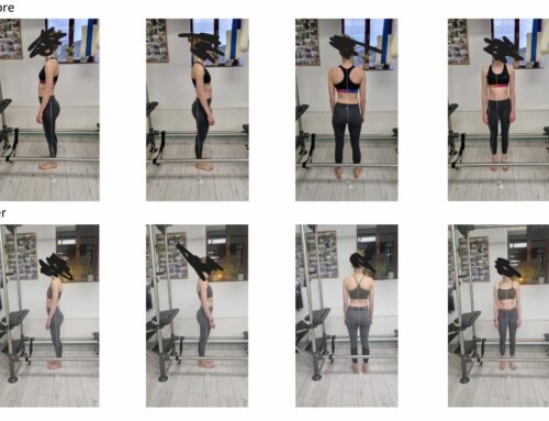 Agne’s 6-Month Journey: Improving Scoliosis & Recovering From Knee Surgery